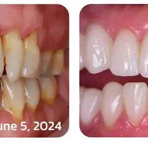 🐝𝐎𝐲𝐢𝐤𝐞𝐲™ Focussmile Bee Venom Treatment Oral Powder 🦷 (🇦🇺 TGA-Certified)