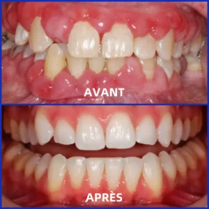 𝐎𝐲𝐢𝐤𝐞𝐲™ Focussmile Poudre de Thérapie Gingivale au Venin d'Abeille