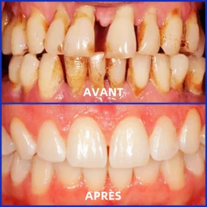 𝐎𝐲𝐢𝐤𝐞𝐲™ Focussmile Poudre de Thérapie Gingivale au Venin d'Abeille