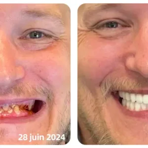 𝐎𝐲𝐢𝐤𝐞𝐲™ Focussmile Poudre de Thérapie Gingivale au Venin d'Abeille