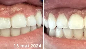 𝐎𝐲𝐢𝐤𝐞𝐲™ Focussmile Poudre de Thérapie Gingivale au Venin d'Abeille