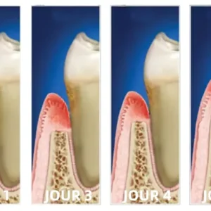 𝐎𝐲𝐢𝐤𝐞𝐲™ Focussmile Poudre de Thérapie Gingivale au Venin d'Abeille