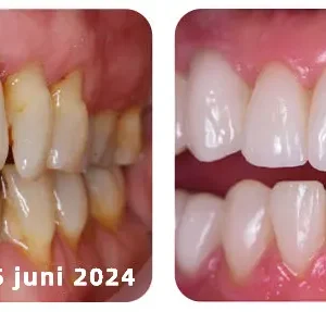 𝐎𝐲𝐢𝐤𝐞𝐲™ Focussmile Poudre de Thérapie Gingivale au Venin d'Abeille