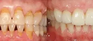 𝐎𝐲𝐢𝐤𝐞𝐲™ Focussmile Poudre de Thérapie Gingivale au Venin d'Abeille