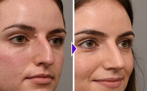 NosaNova Nose Sculpting Device