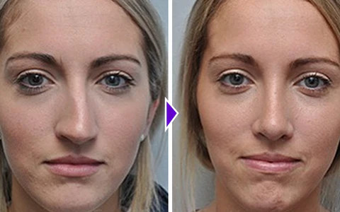NosaNova Nose Sculpting Device