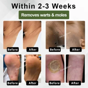 DermaEase™ Spotless Tag and WartRemoval Gel