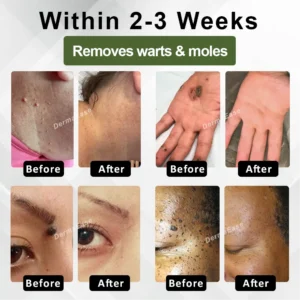 DermaEase™ Spotless Tag and WartRemoval Gel