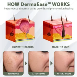 DermaEase™ Spotless Tag and WartRemoval Gel