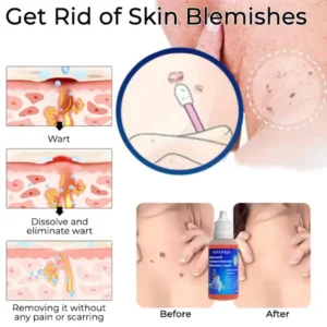 Fivfivgo™ WartsOff Instant Blemish Removal Liquid