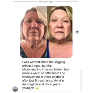 Glow Microneedling Infusion System™