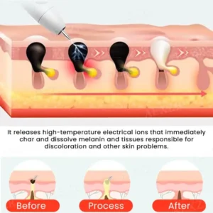 Hudfil™ Portable Skin Care Laser Pen
