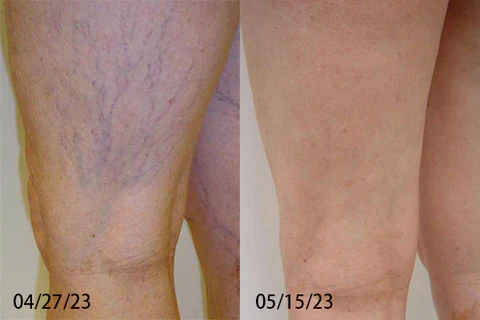 Leech Varicose Vein Cream