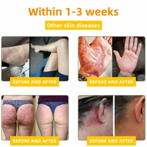 NESLEMY™ Bee Venom Skin Cream（👨‍⚕AAD Recommended)