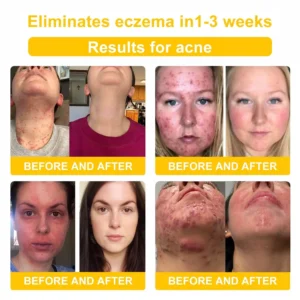 NESLEMY™ Bee Venom Skin Cream（👨‍⚕AAD Recommended)