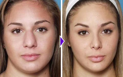NosaNova Nose Sculpting Device