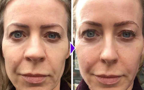 NosaNova Nose Sculpting Device