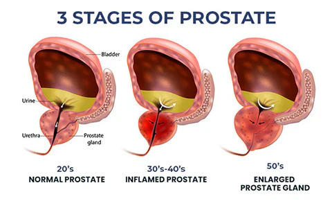 Oveallgo™ PRO ProstaAce PT-141 Nasal Spray