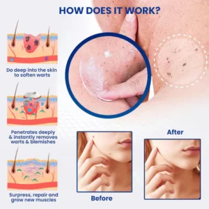 Oveallgo™ PRO WartsOff Instant Blemish Removal Cream