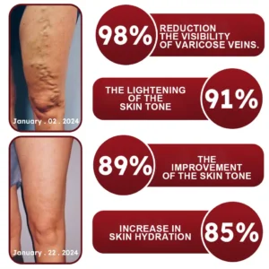 RAINDEW™ Leech Varicose Vein Cream