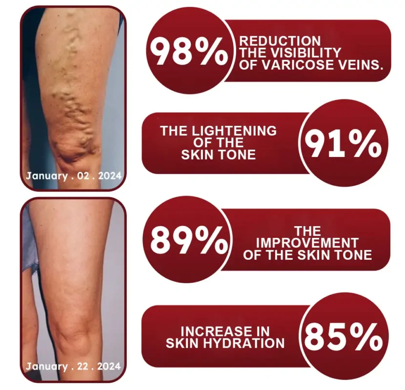 RAINDEW™ Leech Varicose Vein Cream