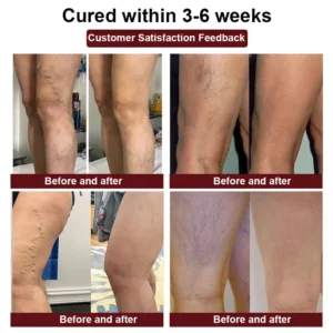 RAINDEW™ Leech Varicose Vein Cream