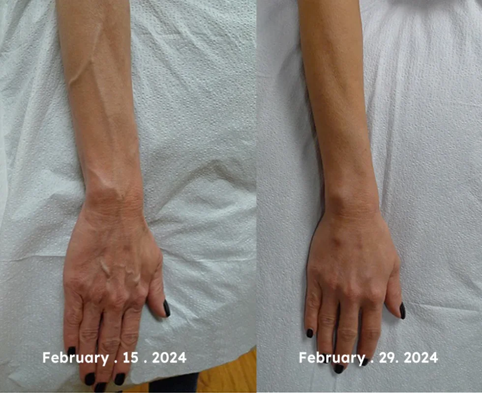 RAINDEW™ Leech Varicose Vein Cream