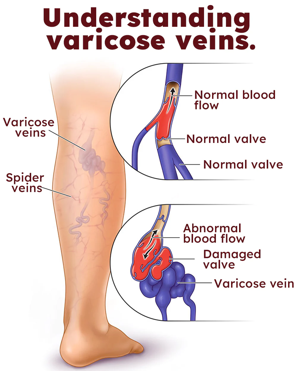 RAINDEW™ Leech Varicose Vein Cream