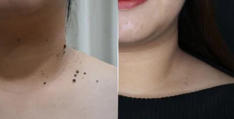 Skinetiv™ Moles & Warts Removing Skin Tag Patch