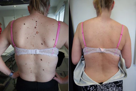 Skinetiv™ Moles & Warts Removing Skin Tag Patch