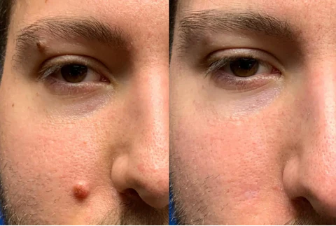 Skinetiv™ Moles & Warts Removing Skin Tag Patch