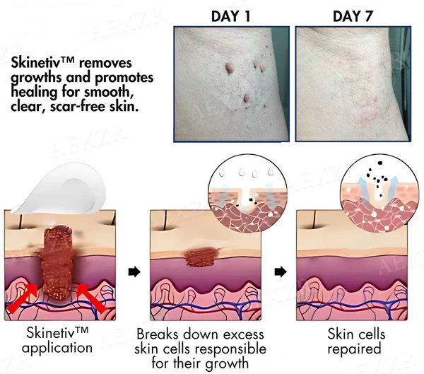 Skinetiv™ Moles & Warts Removing Skin Tag Patch