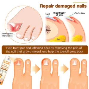 UNPREE™ Kolirin Bee Venom Nail Fungus Spray