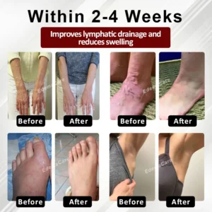 Winter Sale EdemaCare™ Horse Chestnut VenoLymph Massage Cream