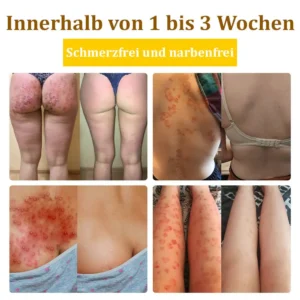 flysmus™Bienengift-Behandlungscreme🐝: Behandlung von Ekzemen, Akne, Altersflecken, Krampfadern, Hautrissen, Pilzinfektionen, Warzen