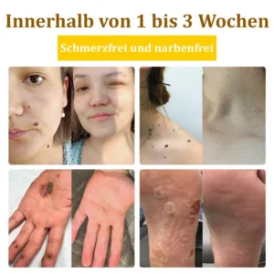 flysmus™Bienengift-Behandlungscreme🐝: Behandlung von Ekzemen, Akne, Altersflecken, Krampfadern, Hautrissen, Pilzinfektionen, Warzen