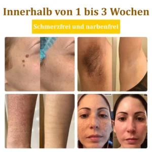 flysmus™Bienengift-Behandlungscreme🐝: Behandlung von Ekzemen, Akne, Altersflecken, Krampfadern, Hautrissen, Pilzinfektionen, Warzen
