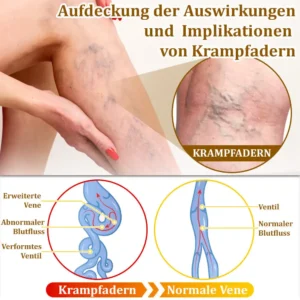 flysmus™Bienengift-Behandlungscreme🐝: Behandlung von Ekzemen, Akne, Altersflecken, Krampfadern, Hautrissen, Pilzinfektionen, Warzen