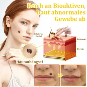 flysmus™Bienengift-Behandlungscreme🐝: Behandlung von Ekzemen, Akne, Altersflecken, Krampfadern, Hautrissen, Pilzinfektionen, Warzen