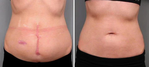 Advanced Scar Spray For All Types of Scars - For example Acne Scars, Surgical Scars and Stretch Marks
