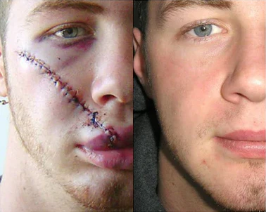 Advanced Scar Spray For All Types of Scars - For example Acne Scars, Surgical Scars and Stretch Marks