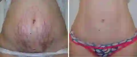 Advanced Scar Spray For All Types of Scars - For example Acne Scars, Surgical Scars and Stretch Marks