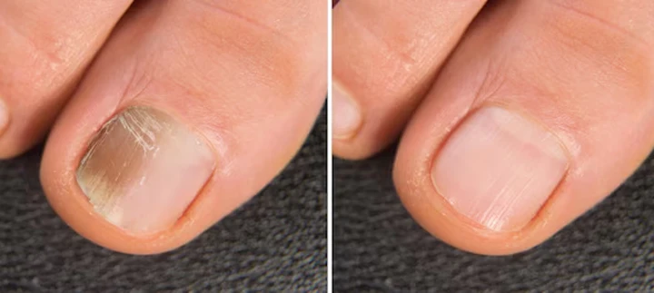 Biancat™ BeeVenom Anti-Fungal Nail Renewal Oil
