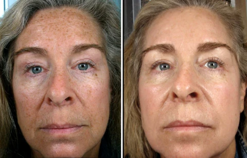 Dobshow™ SpotErase Trio Vitamin C 20% Removal Cream