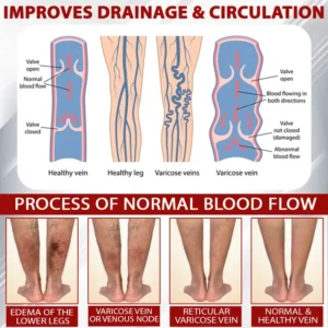 EdemaCare™ LymphDrain Horse Chestnut Massage Cream