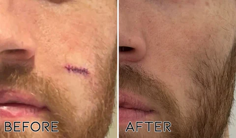 Fivfivgo™ Advanced Silicone Scar Removal Gel