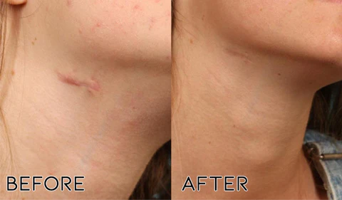 Fivfivgo™ Advanced Silicone Scar Removal Gel