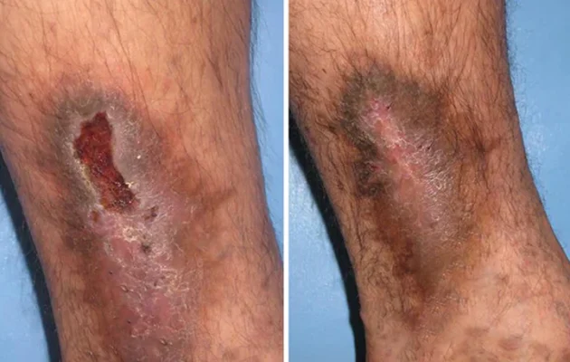 UNPREE™ Kolirin Diabetic Wound Spray