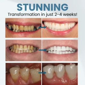 Winter Sale Beezau™ Bee Venom Teeth Restoration Powder