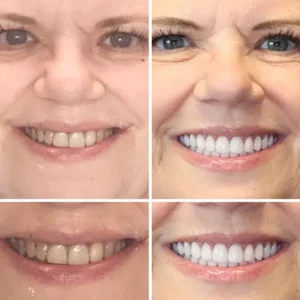 𝐁𝐢𝐤𝐞𝐧𝐝𝐚® Advanced Customized Full Denture Set